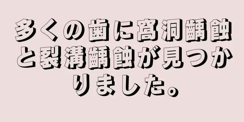 多くの歯に窩洞齲蝕と裂溝齲蝕が見つかりました。