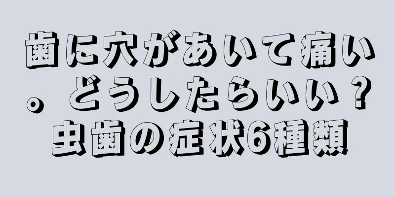 歯に穴があいて痛い。どうしたらいい？虫歯の症状6種類